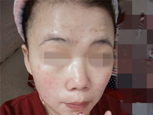 做整容做去痘疤一般多久恢复