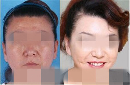昆明自体除皱费用多少钱呢？