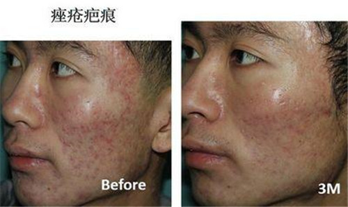 沈阳修复烫伤疤痕多少钱呢？