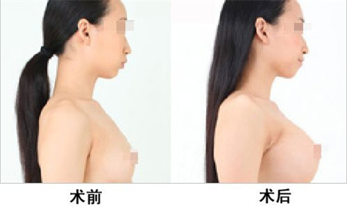 做乳晕漂红三甲大医院同小医院手术费相差大吗
