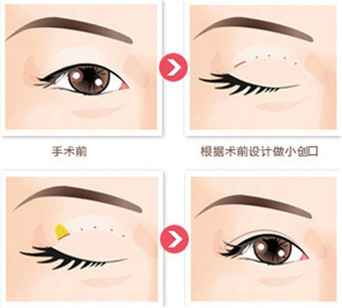 乐山做双眼皮多少钱？手术安全吗？