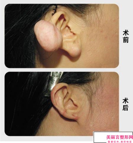 南昌市右耳朵畸形新价格表新版介绍-南昌市右耳朵畸形价格高吗