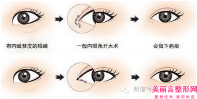 鹰潭市开大眼角恢复价格收费表新版公布(开大眼角恢复均价为：4224元)