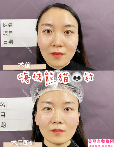 厦门市除皱微创手术医生排行榜看过来-厦门市除皱微创手术整形医生