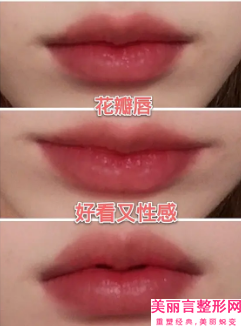 临汾玻尿酸丰唇珠术会不会有后遗症呢