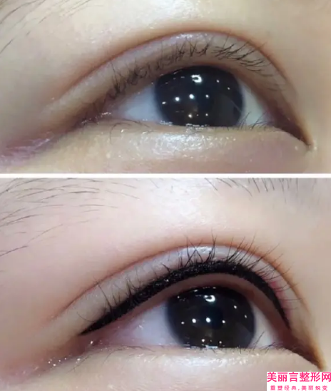 鹰潭眼睑内翻矫正手术后护理好坏对效果的影响