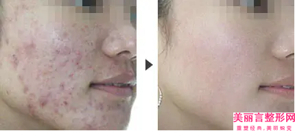湛江志敏口腔门诊部激光去眼袋修复后的效果怎么样