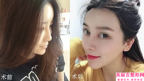 新乡鼻中隔软骨隆鼻术是否会影响生育