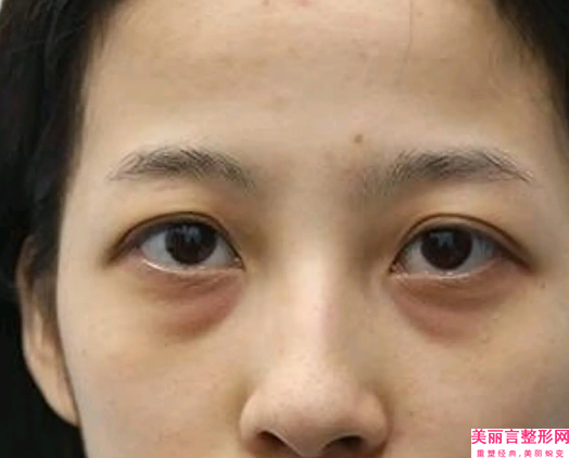 徐州韩式定点双眼皮手术失败后应该如何处理