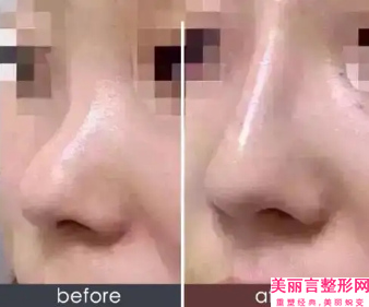 黔东南苗族侗族自治州鼻子敏感肌肤修复医院-雅典娜医学美容整形中心揭晓