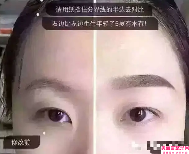 吉安内切去眼袋手术的费用介绍