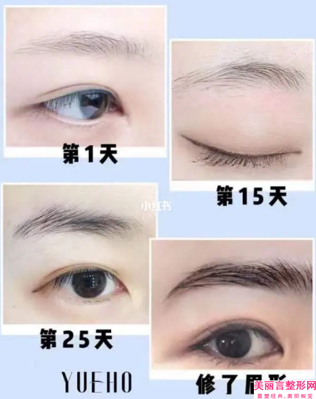 孝感市哪个医院能做hg无痕开眼角(孝感市hg无痕开眼角医院排名榜前十位实力名单公布)