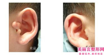 上饶市第二人民医院整形外科耳缺陷整形资料详细介绍-附整形费用表明细