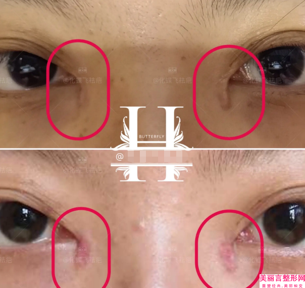 洛阳市割宽双眼皮的医生哪个技术好又便宜(师军涛医生效果图价格)