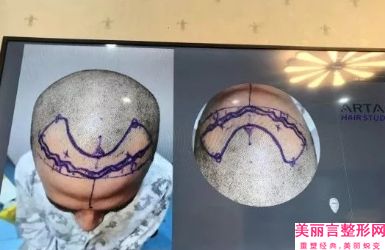 复旦大学附属华东医院整形科,上海九院脱腋毛专家-技术pk