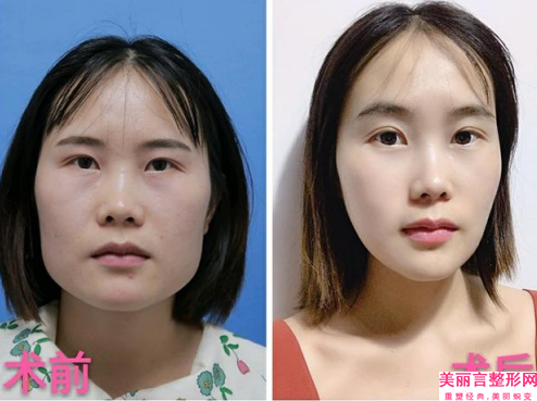 厦门美莱医疗美容怎么样-自体脂肪填充面部僵硬大概什么价格呢