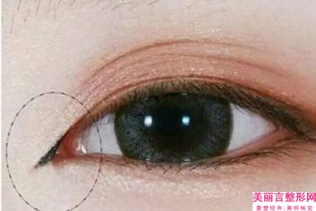 恩施土家族苗族自治州眼角拉皮医生哪几位效果好-覃忠整形医生爱美人士信赖之选