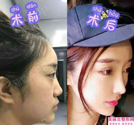 整形胶原蛋白线隆鼻会对我们的身体有伤害吗