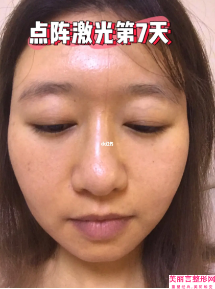 广州市雷涛医生,陈坦医生面部激光溶脂你更看好哪一个