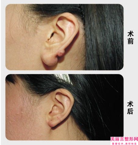长沙艺星医学美容医院有限公司(紧致提升整形)价格(价目)2025公示-耳朵整形手术案例