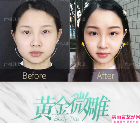 广州市磨骨瘦脸修复收费标准信息上线(磨骨瘦脸修复均价为：35369元)