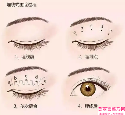 辽宁省面颊部抽脂医院推荐：面颊部抽脂医院前30名票选结果公布