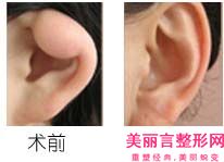 长沙市李高峰医生,钟茜医生小儿耳朵畸形整形看哪个医生技术好