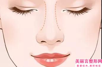 成都市线雕无痕隆鼻多少钱(2025年成都市线雕无痕隆鼻价位表信息)