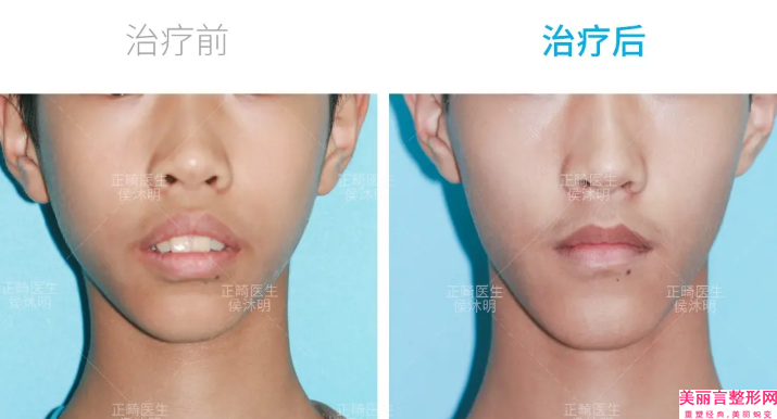 丽水市专业修复兔唇医院哪家比较好(丽水思齐美莱医疗美容诊所实力出众)