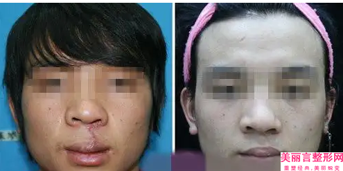株洲点阵激光去除眼皱纹整形手术的效果是不是很好
