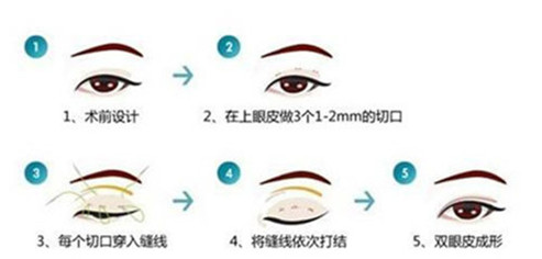 做眼部综合整形效果到底好不好呢