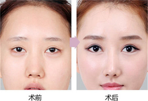 做眼部综合整形什么费用 