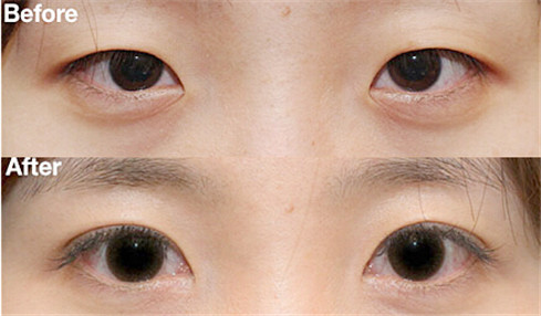 深圳眼部整形手术大概多少钱