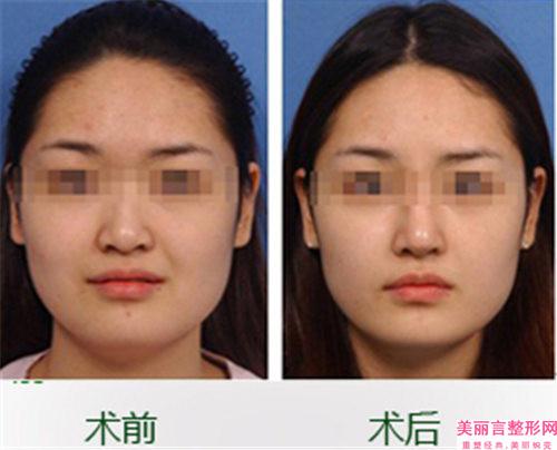 做微晶瓷隆鼻的价格是怎样的呢
