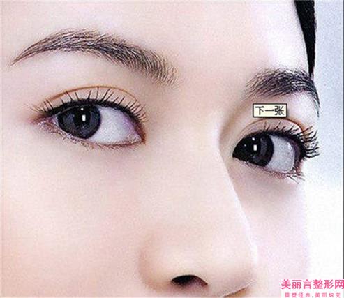 做倒睫双眼皮的价格定位 