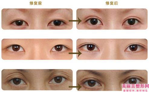 吃多盐能助力鱼泡眼去脂手术后不反复吗？
