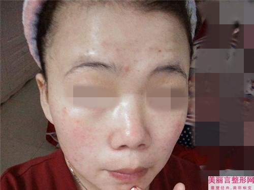 用激光美容点痣需多少钱一个